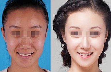 熱拉提的治療效果好不好？多久起效？